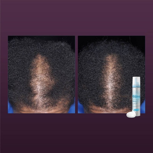 2-Pks Women’s Rogaine Reactivates Hair Growth Supply. Hair read below, please. - Picture 15 of 15